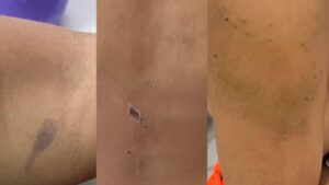 crianca-de-4-anos-e-espancada-por-pai-e-madrasta-em-olinda-e-levada-a-hospital-com-queimaduras-de-cigarro
