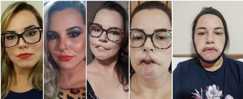 influencer-que-perdeu-labio-por-uso-de-pmma-passa-por-5a-e-possivelmente-ultima-cirurgia-em-sc:-‘terei-meu-sorriso-de-volta’