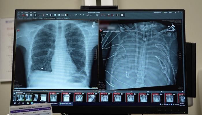 paciente-sobrevive-mais-de-48-horas-sem-pulmoes-apos-medicos-criarem-sistema-artificial-antes-de-transplante